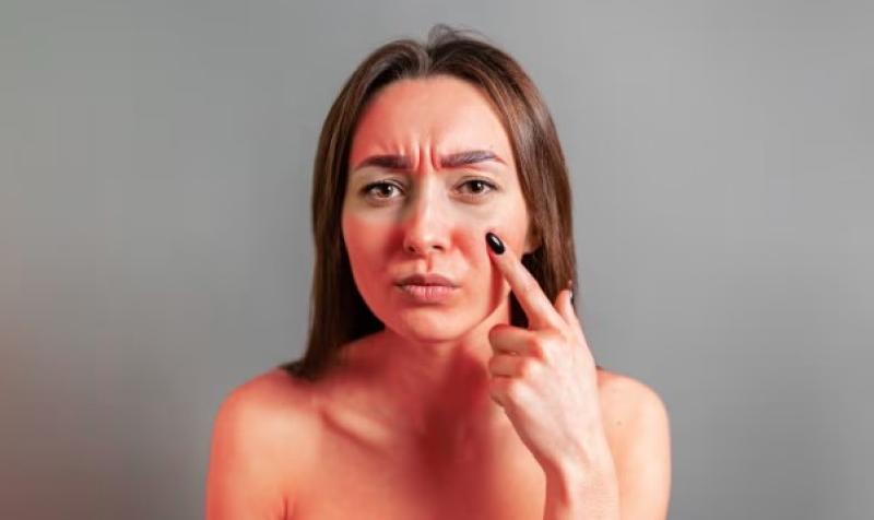 क्या आप भी हैं सनबर्न से परेशान? तो अपनाएं ये घरेलू नुस्खे, मिलेगी राहत